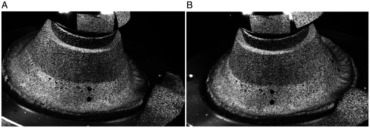 Reverse Total Shoulder Arthroplasty Baseplate Stability in Superior Bone Loss With Augmented Implant.