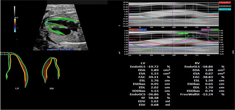 Evaluation of prenatal changes in fetal cardiac morphology and function in maternal diabetes mellitus using a novel fetal speckle-tracking analysis: a prospective cohort study.