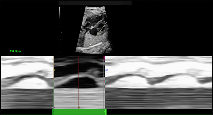 Evaluation of prenatal changes in fetal cardiac morphology and function in maternal diabetes mellitus using a novel fetal speckle-tracking analysis: a prospective cohort study.