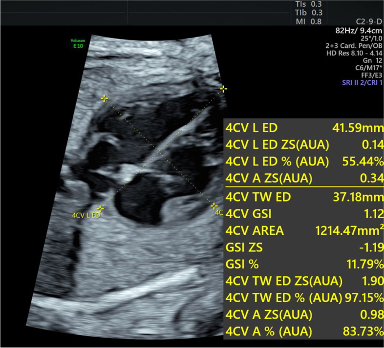 Evaluation of prenatal changes in fetal cardiac morphology and function in maternal diabetes mellitus using a novel fetal speckle-tracking analysis: a prospective cohort study.