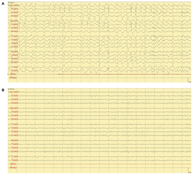 Recurrent Altered Mental State Associated with Nonhepatic Hyperammonemia Presented in an Elderly Female Patient: Probable Late-Onset Urea Cycle Disorder.