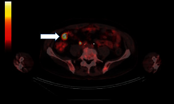 Retrograde Balloon-Assisted Deep Enteroscopy in the Diagnosis of Metastatic Melanoma.