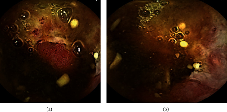 Retrograde Balloon-Assisted Deep Enteroscopy in the Diagnosis of Metastatic Melanoma.