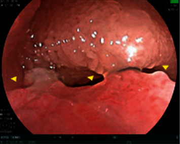 Retrograde Balloon-Assisted Deep Enteroscopy in the Diagnosis of Metastatic Melanoma.