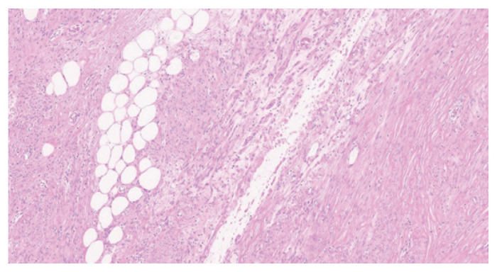 Extraabdominal parasitic lipoleiomyoma.