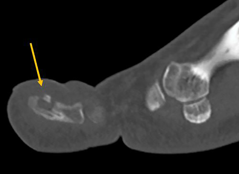 Osteoid Osteoma of the Hallux: A Diagnostic Challenge.