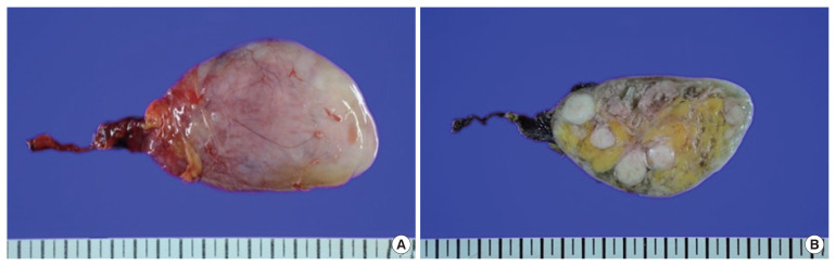 Extraabdominal parasitic lipoleiomyoma.