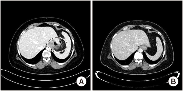 Endoscopic Septotomy as a Treatment for Chronic Leak after Laparoscopic Sleeve Gastrectomy.