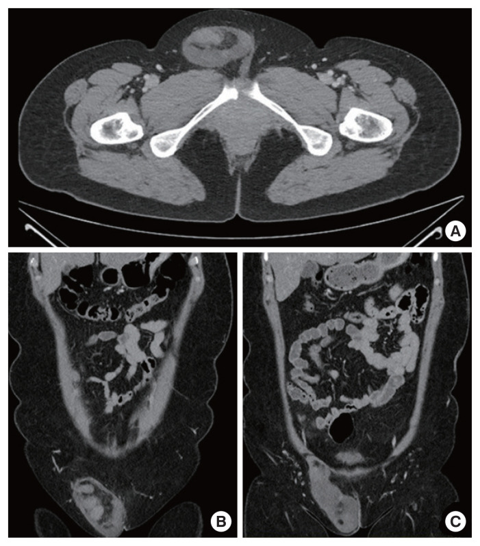 Extraabdominal parasitic lipoleiomyoma.