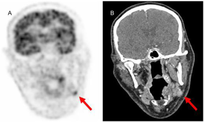 Anti-Tr/DNER antibody paraneoplastic cerebellar degeneration preceding a very late relapse of Hodgkin Lymphoma after 12 years.