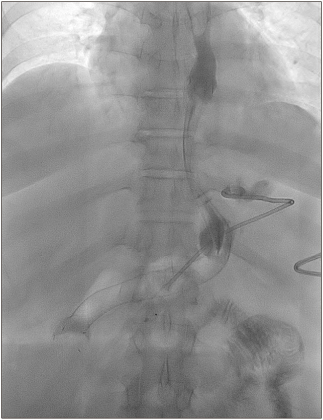 Endoscopic Septotomy as a Treatment for Chronic Leak after Laparoscopic Sleeve Gastrectomy.