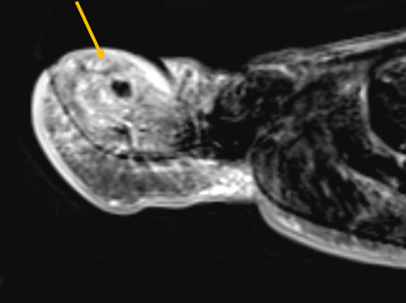 Osteoid Osteoma of the Hallux: A Diagnostic Challenge.