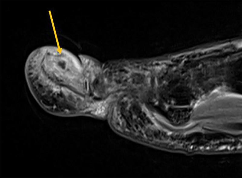 Osteoid Osteoma of the Hallux: A Diagnostic Challenge.