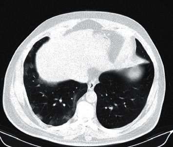 Protracted COVID-19 during Treatment of Facial Palsy.