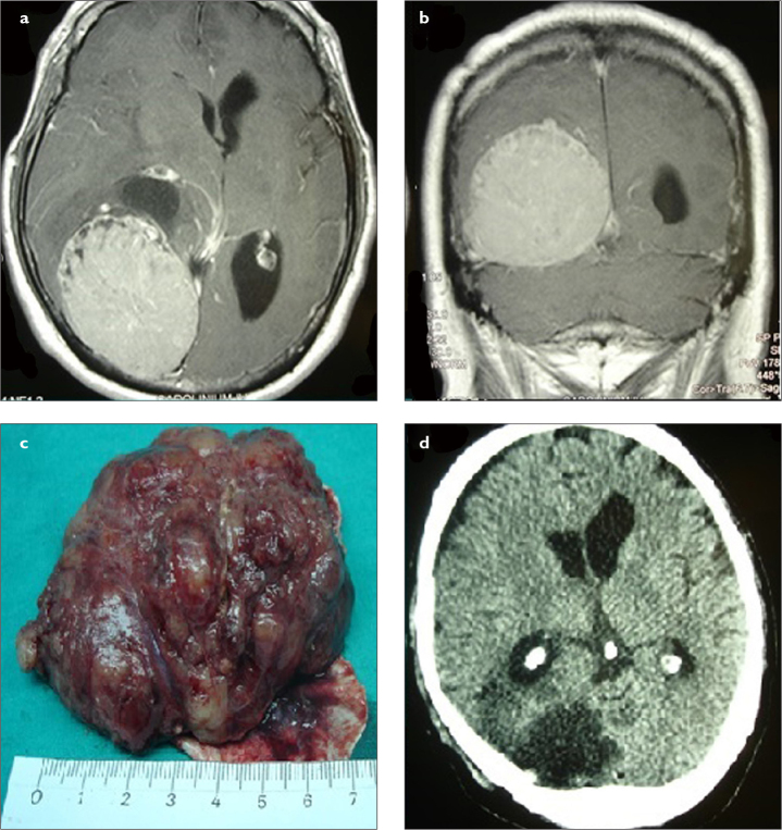 Surgical Management of Giant Intracranial Meningiomas.