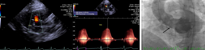 Percutaneous Muscular Ventricular Septal Defect Closure with 2D Transthoracic Echocardiography: Can We Sufficiently Visualize It?