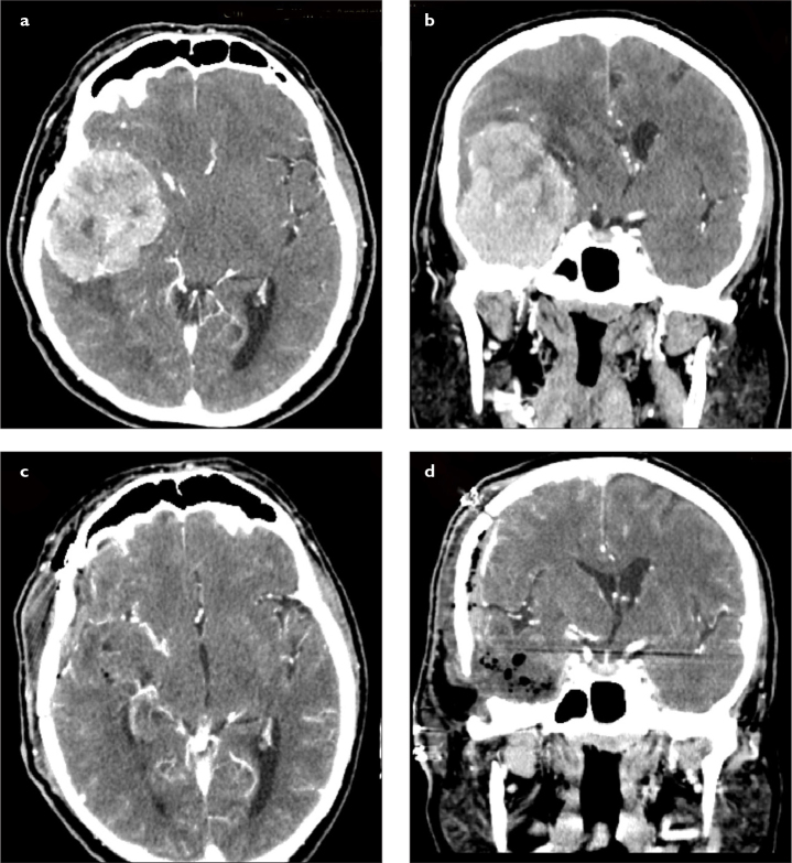 Surgical Management of Giant Intracranial Meningiomas.
