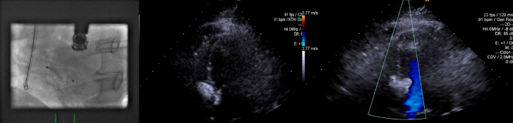 Percutaneous Muscular Ventricular Septal Defect Closure with 2D Transthoracic Echocardiography: Can We Sufficiently Visualize It?