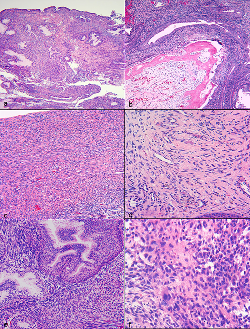 Biphenotypic sinonasal sarcoma: Report of 3 cases with a review of literature