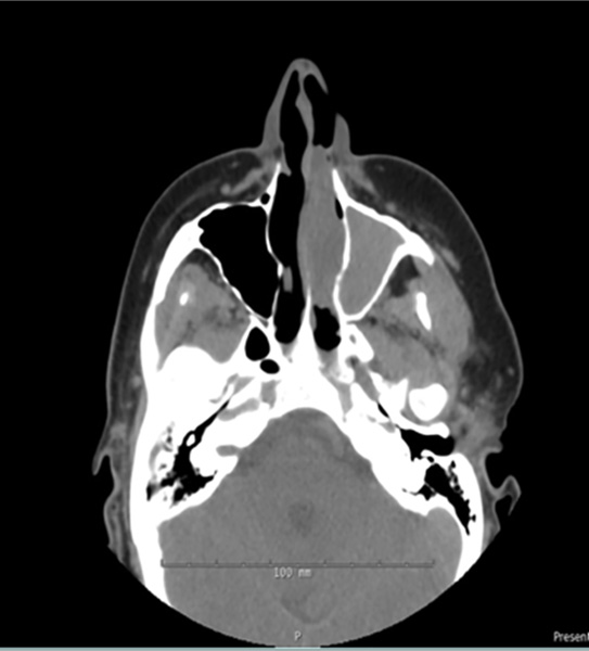 Biphenotypic sinonasal sarcoma: Report of 3 cases with a review of literature