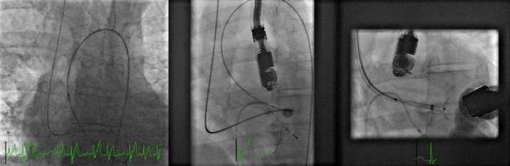Percutaneous Muscular Ventricular Septal Defect Closure with 2D Transthoracic Echocardiography: Can We Sufficiently Visualize It?