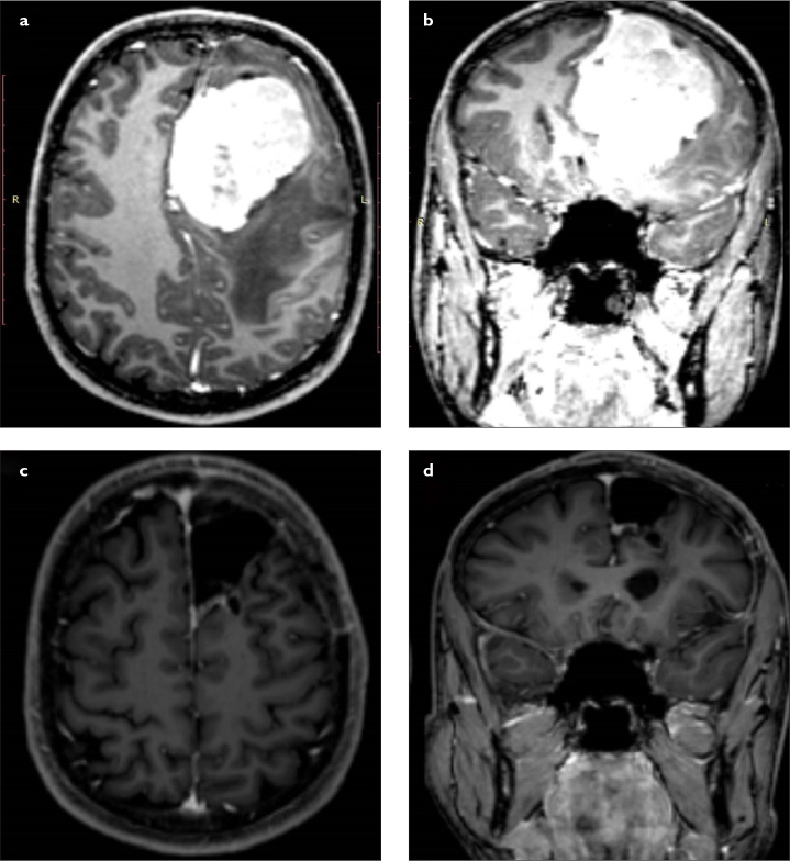 Surgical Management of Giant Intracranial Meningiomas.