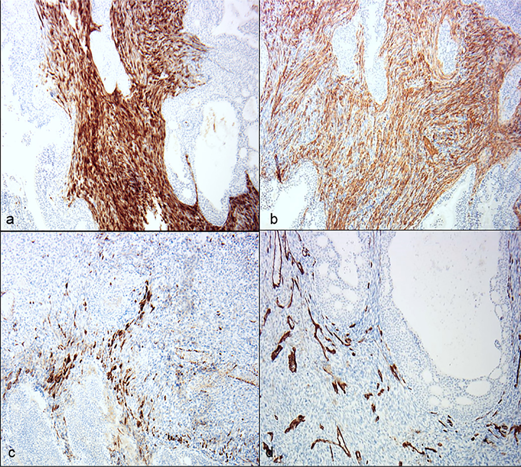 Biphenotypic sinonasal sarcoma: Report of 3 cases with a review of literature