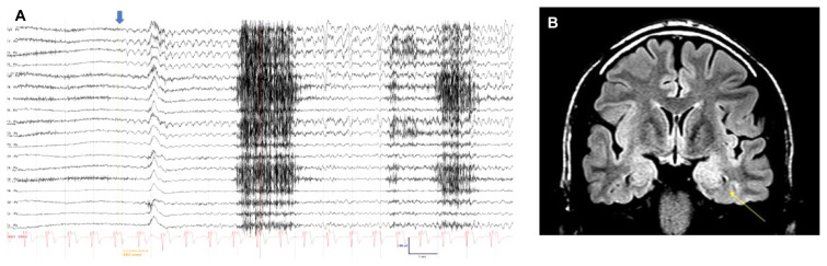 Ictal Swearing as a Lateralizing Value for the Dominant Hemisphere in Temporal Lobe Epilepsy.