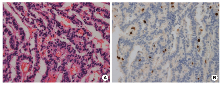 Tumor grade 2 as the independent predictor for lymph node metastasis in 10-20 mm sized rectal neuroendocrine tumor.