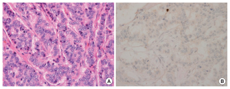 Tumor grade 2 as the independent predictor for lymph node metastasis in 10-20 mm sized rectal neuroendocrine tumor.