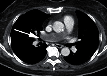 Pulmonary Artery Intimal Sarcoma Diagnosed Preoperatively by Endovascular Biopsy and Treated via Right Pneumonectomy and Pulmonary Arterioplasty.