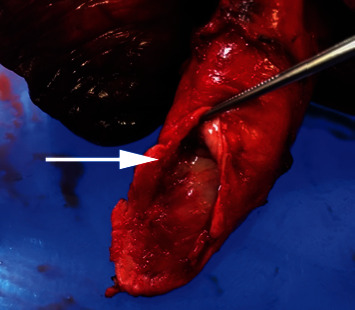 Pulmonary Artery Intimal Sarcoma Diagnosed Preoperatively by Endovascular Biopsy and Treated via Right Pneumonectomy and Pulmonary Arterioplasty.