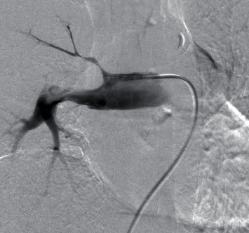 Pulmonary Artery Intimal Sarcoma Diagnosed Preoperatively by Endovascular Biopsy and Treated via Right Pneumonectomy and Pulmonary Arterioplasty.