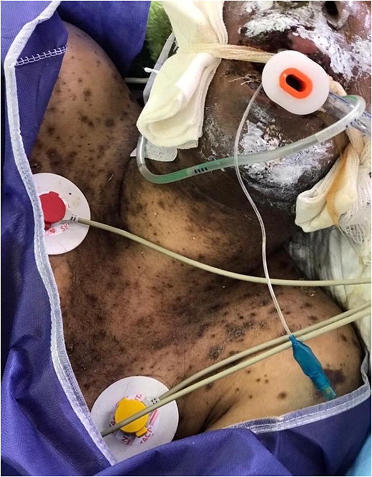 Hyperpigmentation, severe alopecia, and six days of instability in a case of severe methotrexate hypersensitivity reaction.