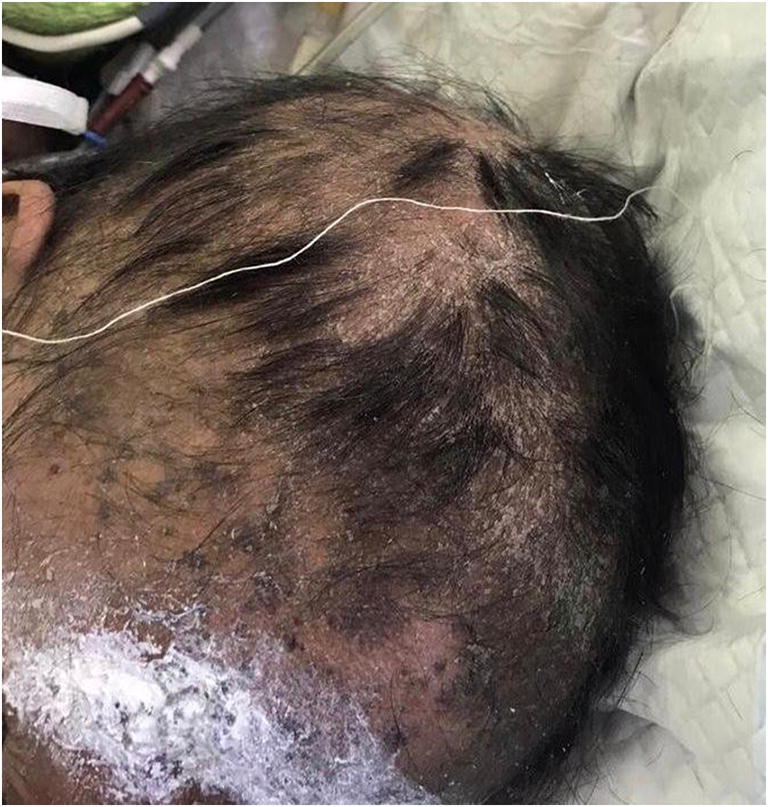 Hyperpigmentation, severe alopecia, and six days of instability in a case of severe methotrexate hypersensitivity reaction.