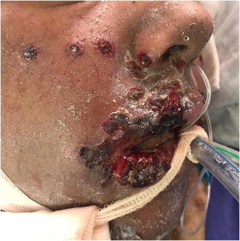 Hyperpigmentation, severe alopecia, and six days of instability in a case of severe methotrexate hypersensitivity reaction.