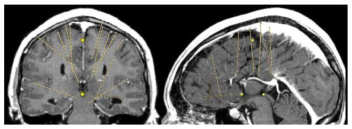 Alternate Seizure Spread with Agenesis of the Corpus Callosum.