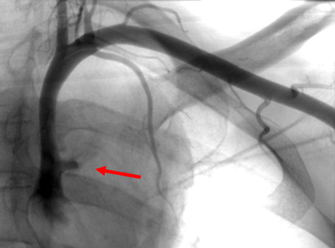 Endovascular Management of a Subclavian Arterial Injury During Central Venous Catheter Placement for Hemodialysis.