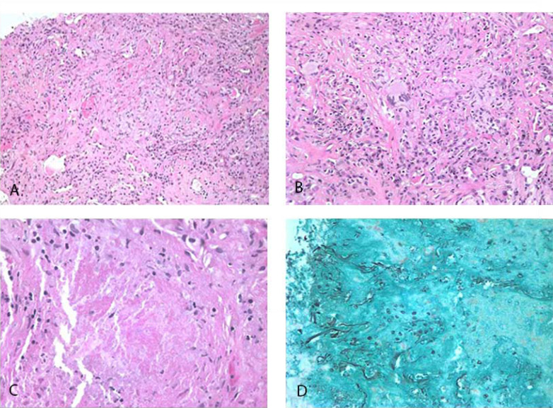 Granulomatous <i>Pneumocystis jiroveci</i> Pneumonia in an HIV-Positive Patient on Antiretroviral Therapy: A Diagnostic Challenge.