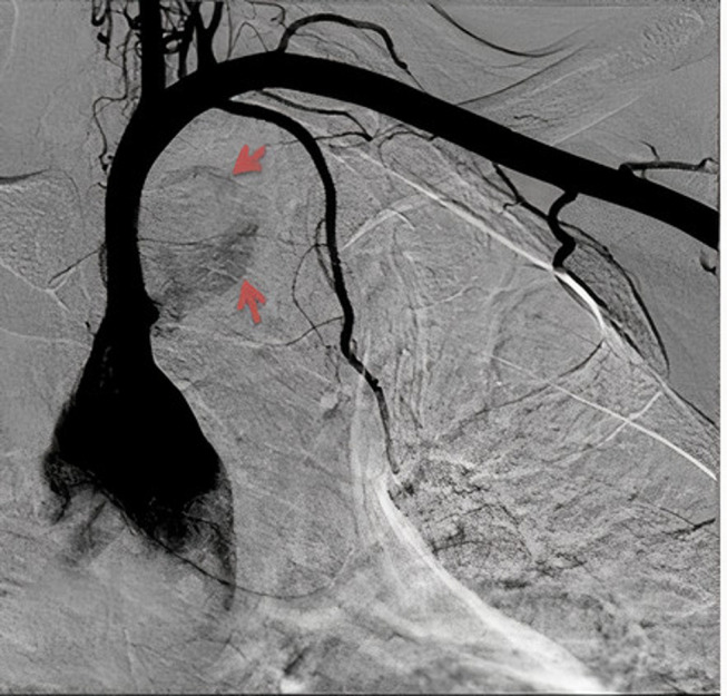 Endovascular Management of a Subclavian Arterial Injury During Central Venous Catheter Placement for Hemodialysis.