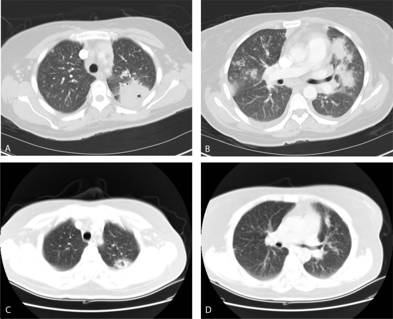 Granulomatous <i>Pneumocystis jiroveci</i> Pneumonia in an HIV-Positive Patient on Antiretroviral Therapy: A Diagnostic Challenge.