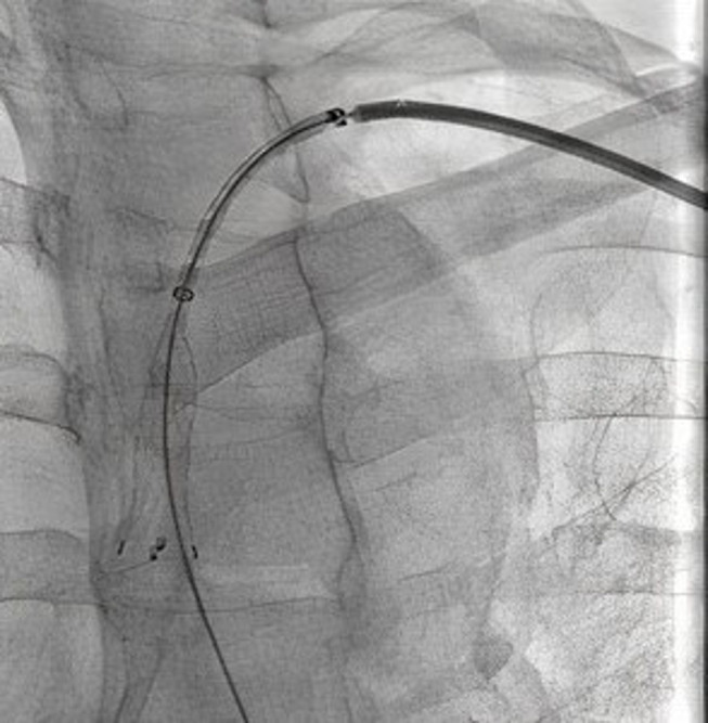 Endovascular Management of a Subclavian Arterial Injury During Central Venous Catheter Placement for Hemodialysis.