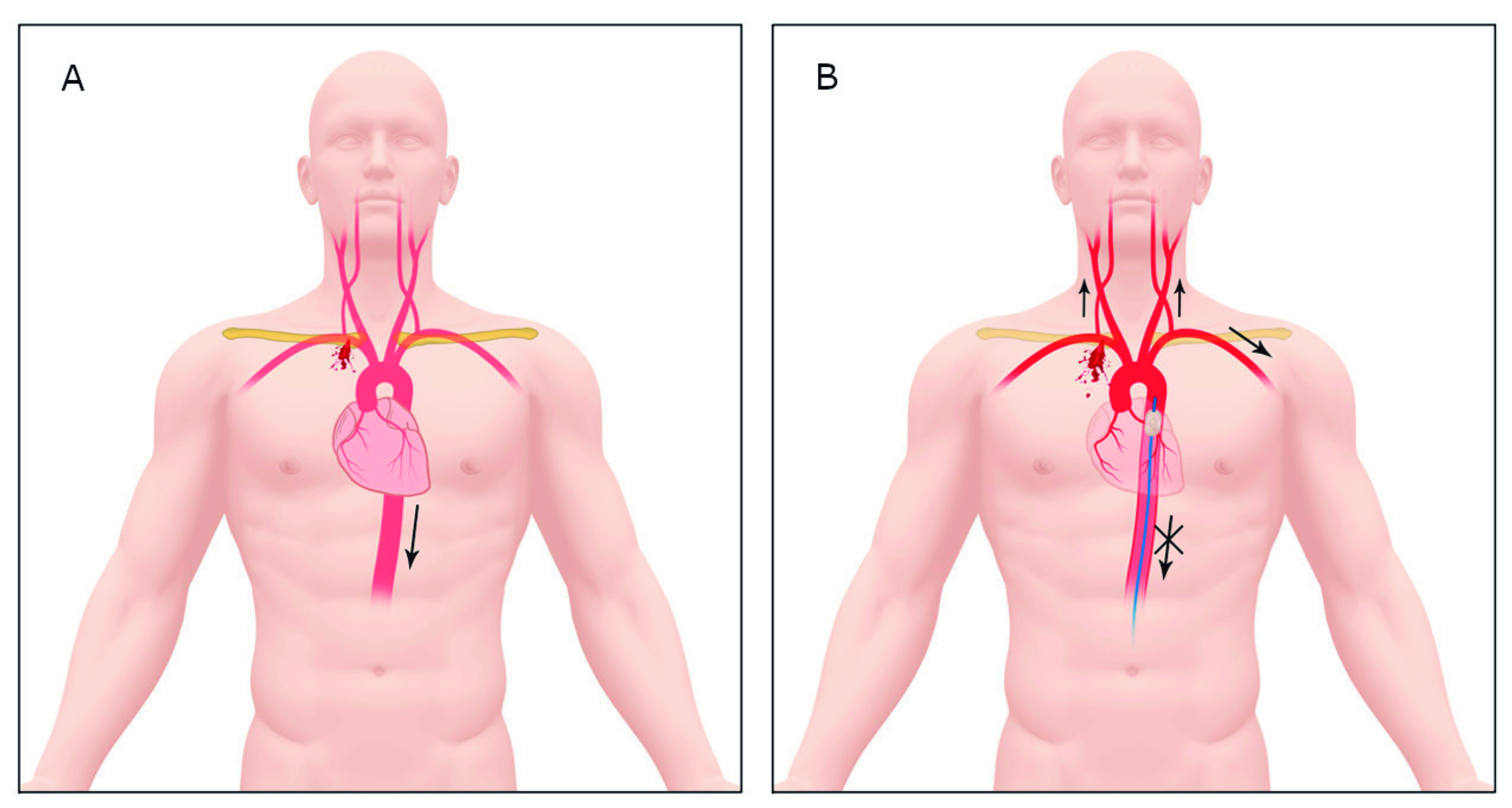 Damage control surgery for thoracic outlet vascular injuries: the new resuscitative median sternotomy plus REBOA.