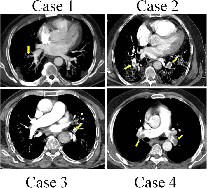 Increased pulmonary embolism in patients with COVID-19: a case series and literature review.