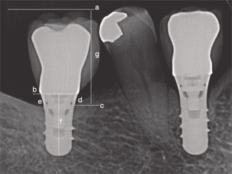 A within-subject comparison of short implants in the posterior region: retrospective study of up to 10 years.