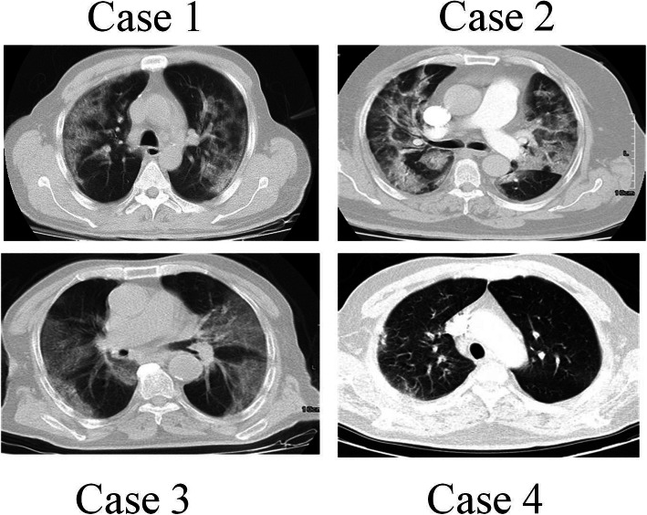 Increased pulmonary embolism in patients with COVID-19: a case series and literature review.