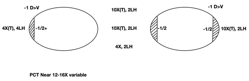 A Post-Surgical Stereovision Surprise in an Adult With an Exotropia Since Infancy Previously Managed, at Two Years With Surgery.