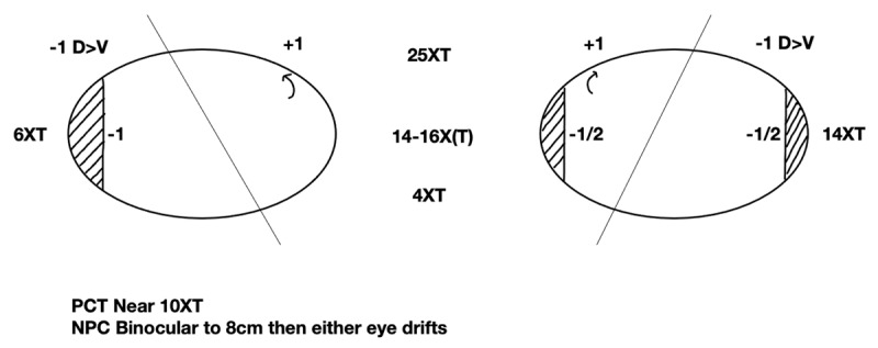 A Post-Surgical Stereovision Surprise in an Adult With an Exotropia Since Infancy Previously Managed, at Two Years With Surgery.