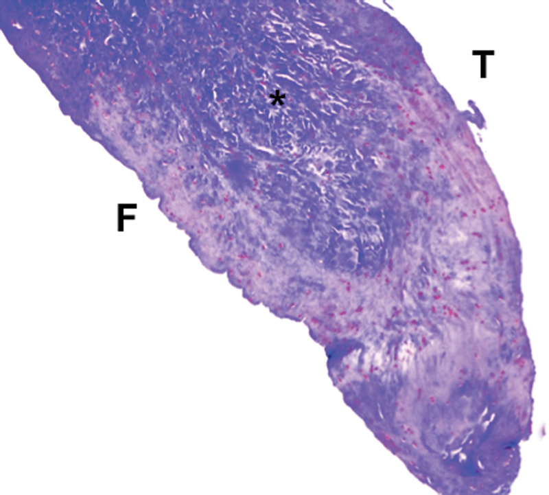 Histological Study of Discoid Lateral Meniscus in Children and Adolescents: Morphogenetic Considerations.