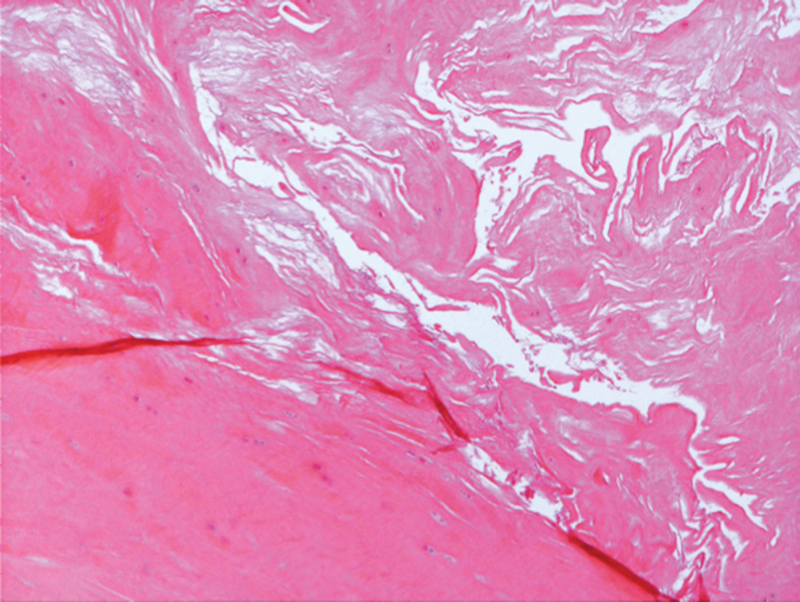 Histological Study of Discoid Lateral Meniscus in Children and Adolescents: Morphogenetic Considerations.